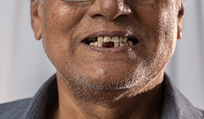 close up of an older man’s mouth with missing teeth