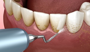 Removing plaque and tartar from around the gum line